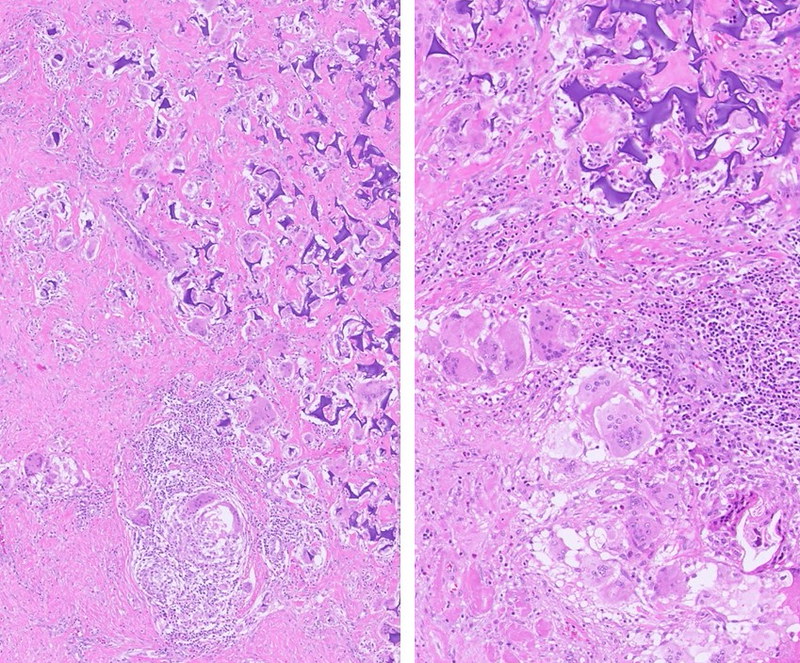 Gelfoam with foreign body reaction - Meningioma biopsy site