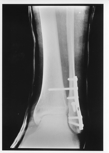 broken_foot_1 | by DaveCube