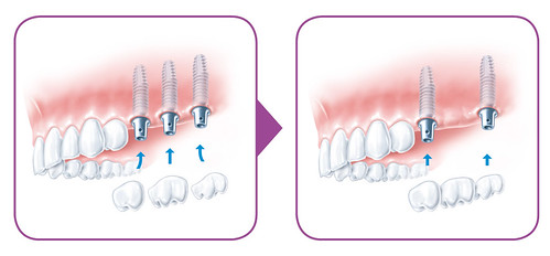 Zobu implanti / Dental implants in Riga