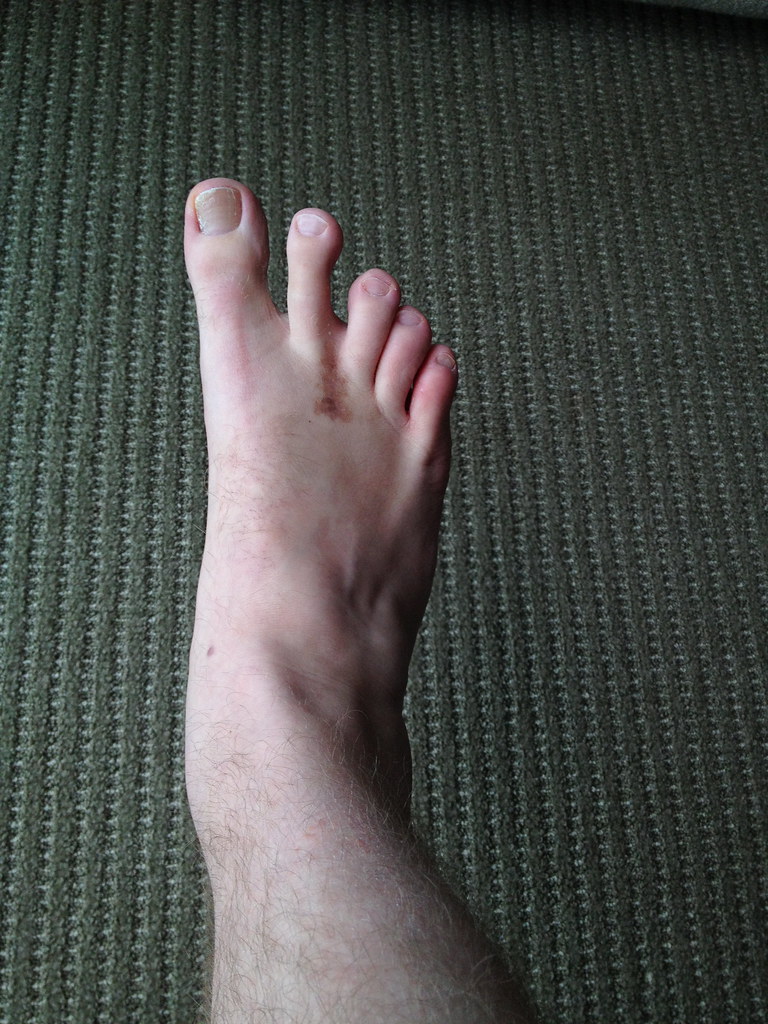Recovery & scars from Morton's Neuroma Surgery | Chris Freeland | Flickr