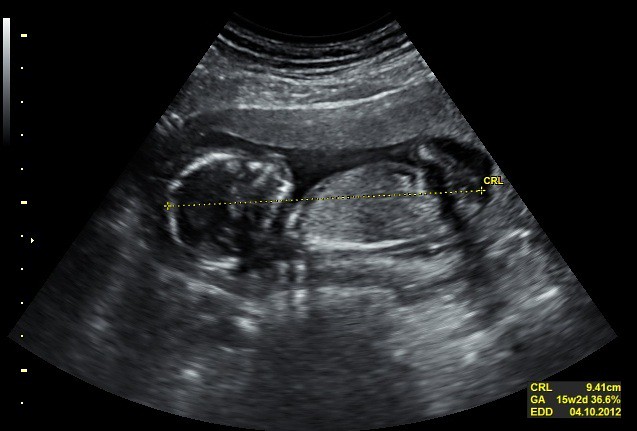 15 weeks Baby in 2D Ultrasound | 15 weeks baby image in 2D ...
