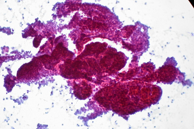 Papillary Thyroid Carcinoma, FNA, Rapid Pap Stain