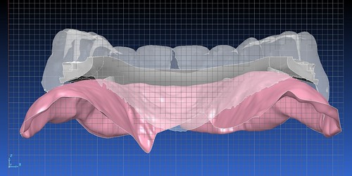 Implant Supported Overdenture | by www.allthingsdentistry.com