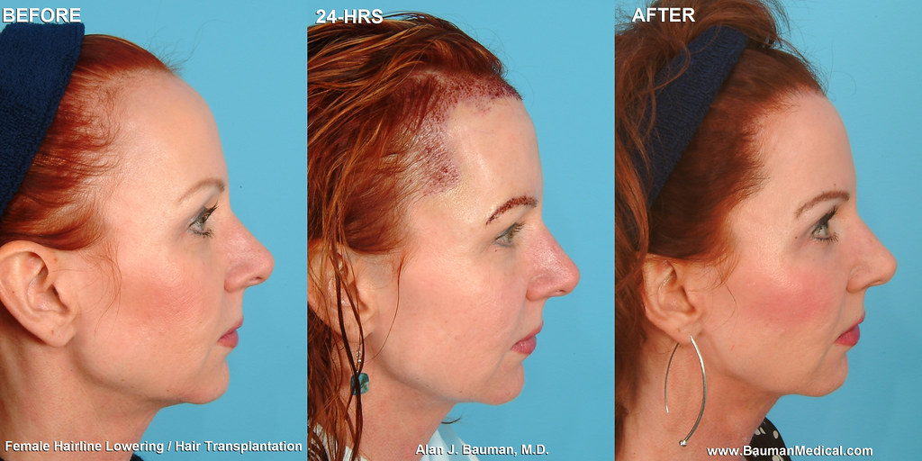 Female Hairline Lowering - Hair Transplant | Hair Transplant… | Flickr