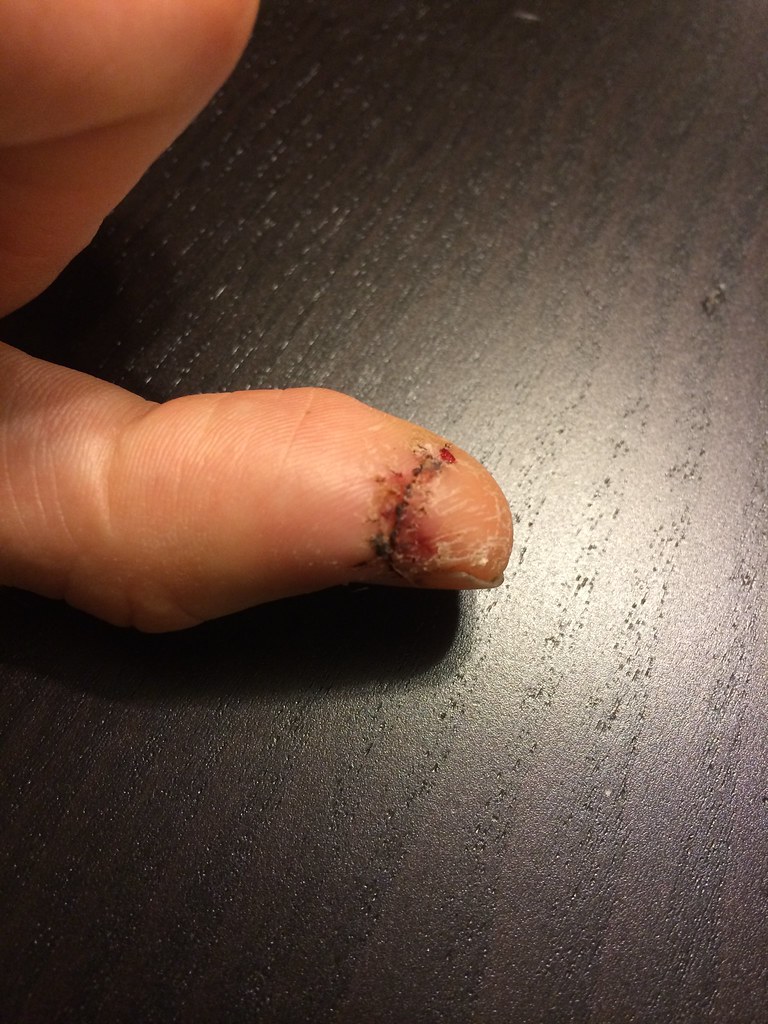 Frankenthumb