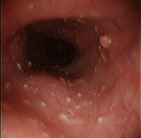 Squamous cell papilloma of esophagus