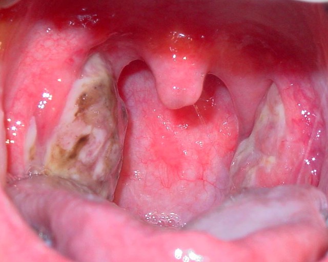 acute suppurative tonsillitis