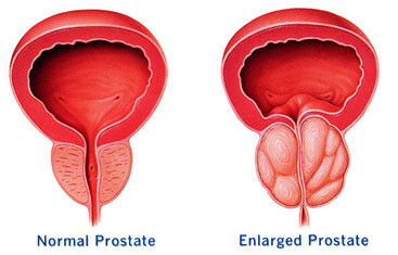 Enlarged Prostate