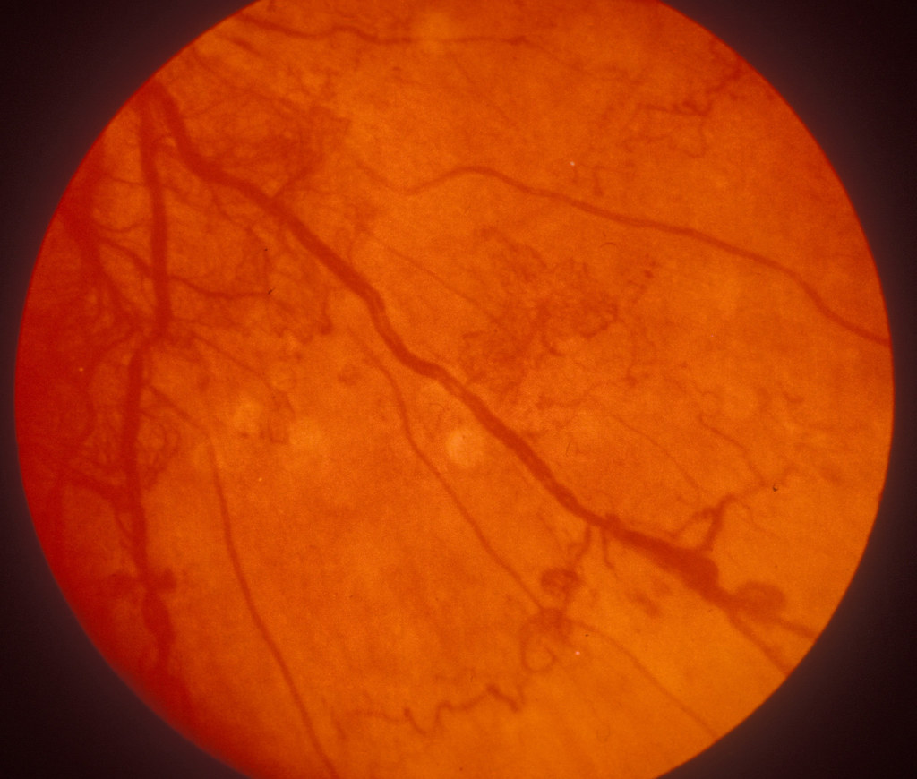 Гипертоническая ангиопатия обоих глаз. Атеросклеротическая ретинопатия. Пролиферативная диабетическая ретинопатия.