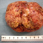 Qiao's Pathology: Testicular Tumor - Mixed Germ Cell Tumor