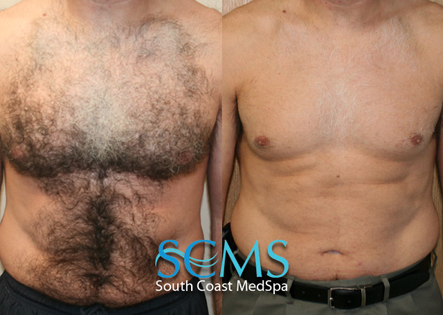 Update more than 152 chest hair removal best