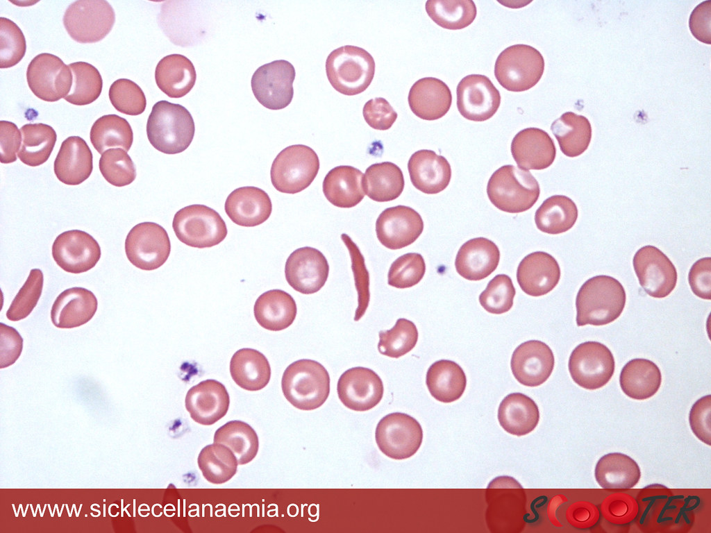 Эритроциты при серповидно клеточной анемии. Серповидноклеточная анемия мазок крови препарат. Картина крови при серповидноклеточной анемии. Мазок крови при серповидноклеточной анемии. Серповидноклеточная анемия эритроциты.