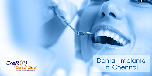 Dental Implants in Chennai | by kalaiyarasikalai14