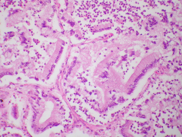 Metastatic pancreatic adenocarcinoma with lepidic growth pattern  Case 280