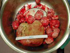 31 fibroids removed from 40 gestational week size uterus at myomectomy