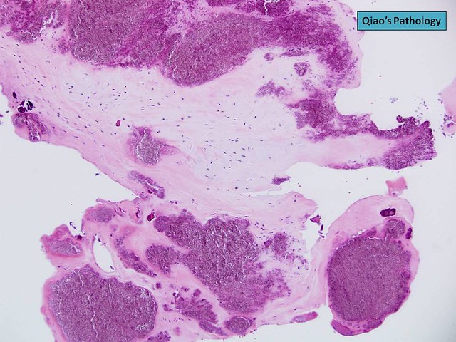 Qiao's Pathology: Pseudogout {Calcium Pyrophosphate Dihydrate Disease (CPPD)}