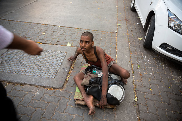 A disfigured beggar in Mumbai, India.