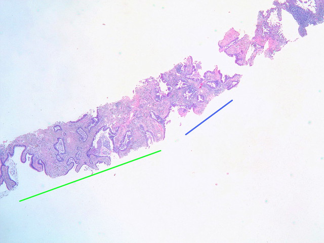 Carcinoma in situ arising in bronchiolar metaplasia co-existing with invasive adenocarcinoma Case 274