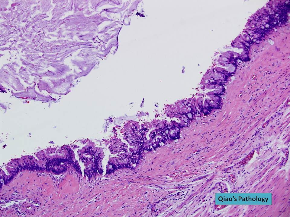 Qiao's Pathology: Mucinous Cystadenoma of Appendix | Flickr