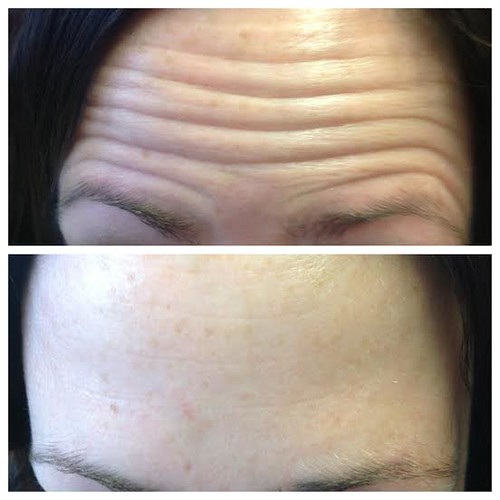 botox before and 2 weeks after forehead on movement | by amandapierceaesthetics