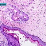 Qiao's Pathology: Ovarian Dermoid Cyst (Mature Cystic Teratoma)
