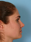 After Revision Rhinoplasty TX