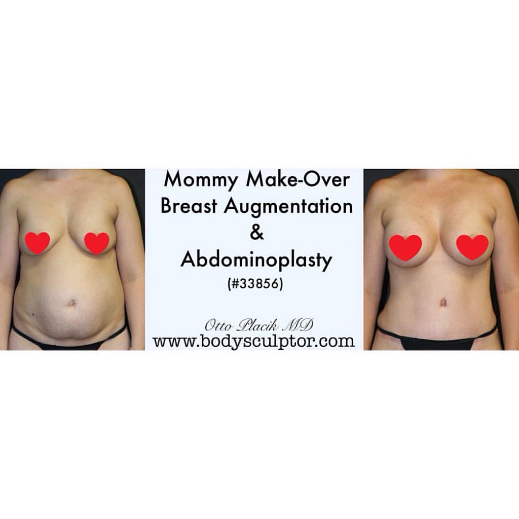 Before & After Abdominoplasty & Breast Augmentation utiliz…
