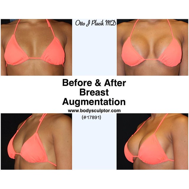 Breast Augmentation utilizing 325cc Moderate Plus Silicone…