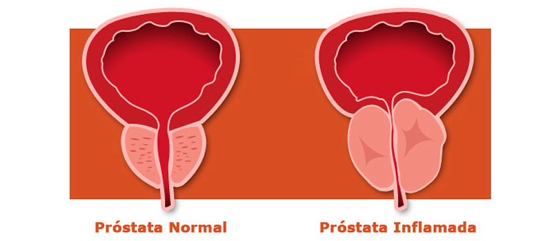 benigna prostata