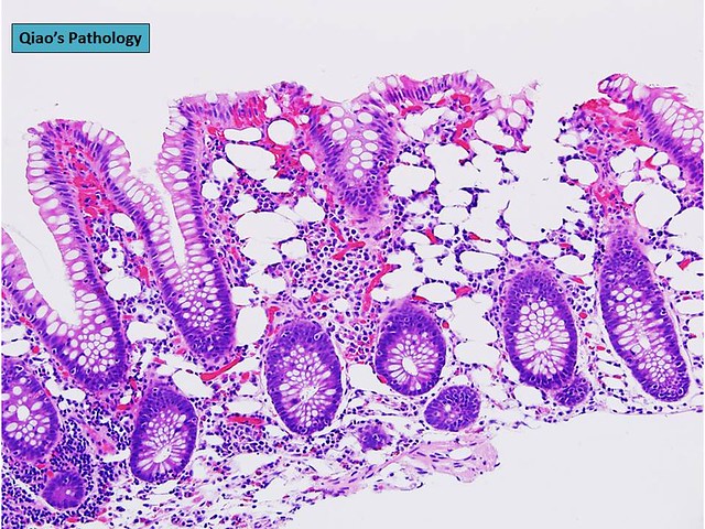 Qiao's Pathology: Mucosal Pseudolipomatosis of the Colon