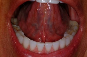 Anatomy Under Tongue