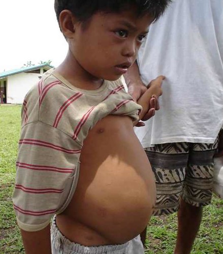 Schistosomiasis in a child (Philippines)