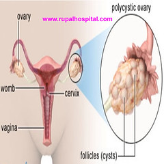 Pcos Treatment, Polycystic Ovarian Syndrome Treatment Clinic India