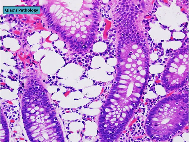 Qiao's Pathology: Mucosal Pseudolipomatosis of the Colon