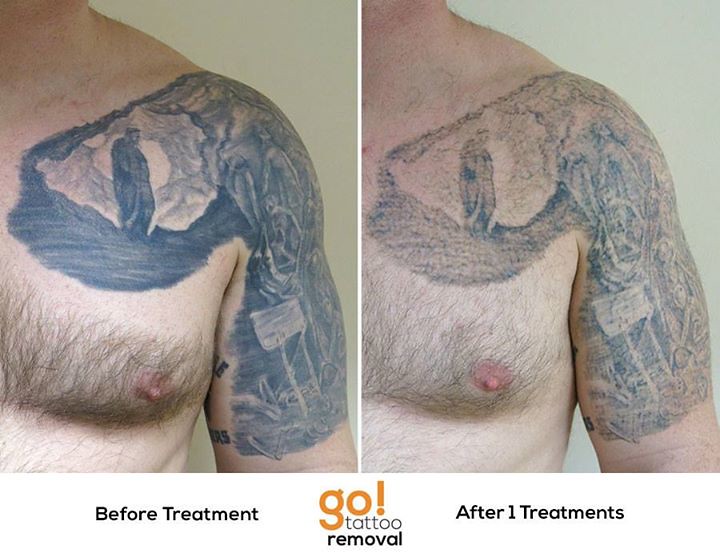 Chest Tattoo Removal Results  Case Study  Removery