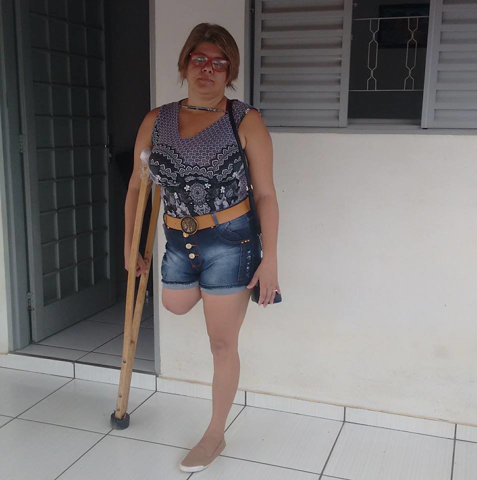 amputee, woman, crutches, onelegged 