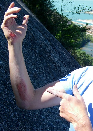 Granite Rash | Aftermath of a 20 meter slab fall on 