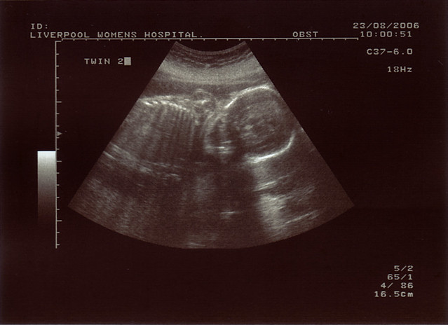 The Twins & Pregnancy | Flickr