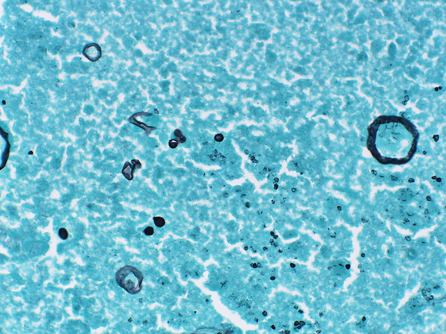 Coccidioidomycosis - GMS stain  Case 227