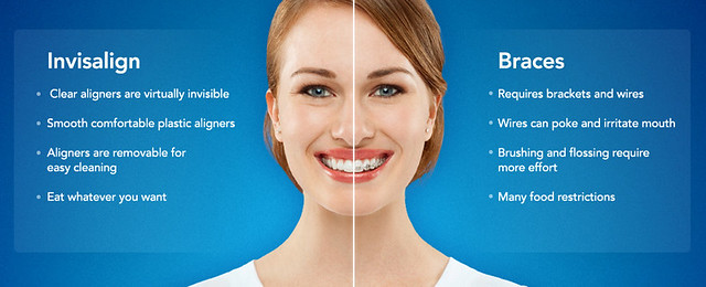 Opt for the Best Invisalign Dentist in San Diego