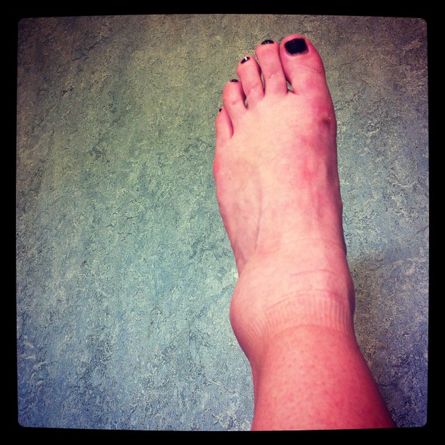 broken ankle, @elt_pics, eltpics