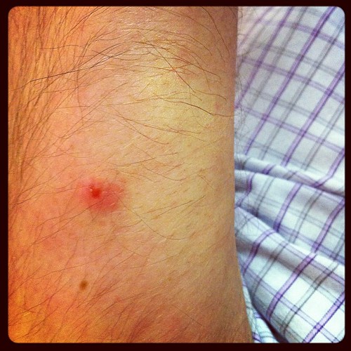Mosquito #bite #instagram #iphonography #itchy #buggers | Flickr
