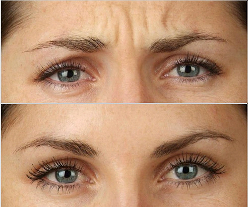 botox1 | by mdwellness