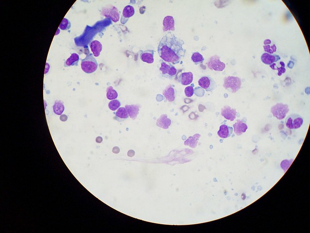 lymph node aspirate from a 3-year old cat losing weight with swollen lymph nodes