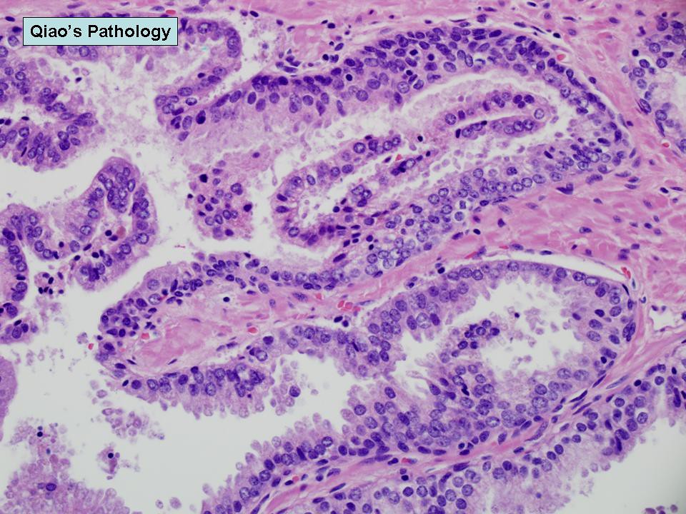 prostate high grade pin pathology outlines)