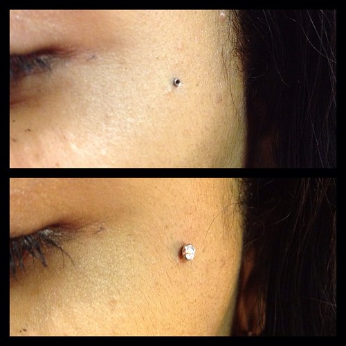 Love if when a good and old, perfectly healed, Microdermal
