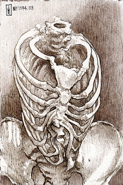 No. 1194.05 - Tuberculosis of the Spine (Pott's Disease) [Mütter Museum]