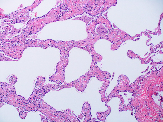 Smoking-related interstitial fibrosis - Case 268