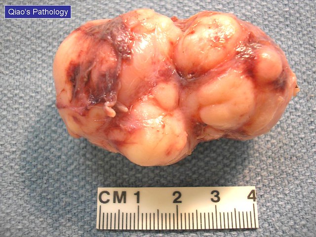 Qiao's Pathology: Juvenile Fibroadenoma of Breast