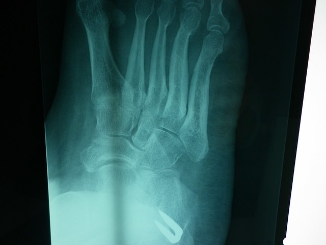 X-rays taken of my feet showing results of operations(age 2 to 9) to correct congenital talipes equinovarus